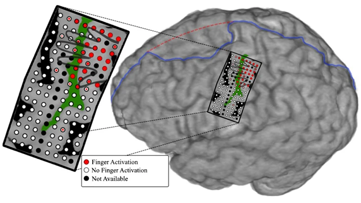 mind-controlled-prosthetics-johns-hopkins