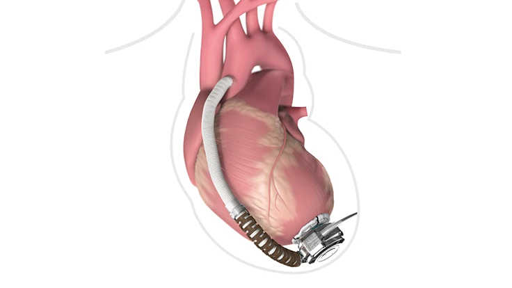 Class I recall for Medtronic’s HeartWare HVAD system