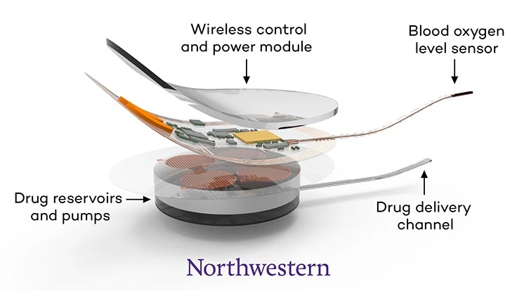 The closed-loop system senses dangerously low oxygen levels, associated with an opioid overdose, and immediately and automatically delivers naloxone.