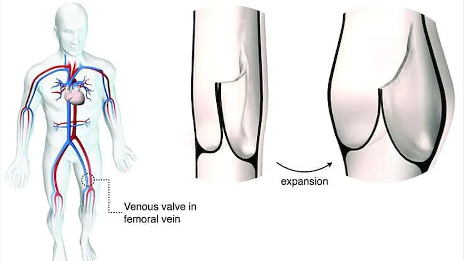 Artistic rendering of human venous valve geometry at rest and during expansion under volume load. This material relates to a paper that appeared in the Feb. 19, 2020, issue of Science Translational Medicine, published by AAAS. The paper, by S.C. Hofferberth at Boston Children's Hospital in Boston, MA; and colleagues was titled, "A geometrically adaptable heart valve replacement.”