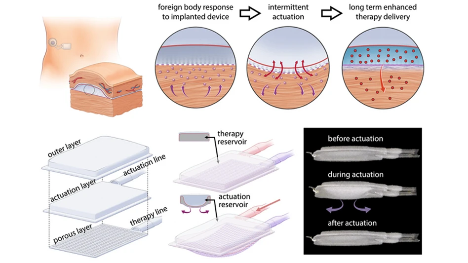 The drug-delivery system includes an actuator that repeatedly inflates and deflates the device for five minutes every 12 hours. This mechanical deflection prevents immune cells from accumulating around the device.