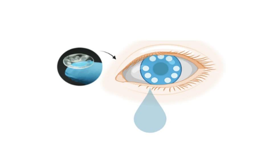 Scientists from the Terasaki Institute for Biomedical Innovation (TIBI) have developed a contact lens that can capture tears for the detection of exosomes, nanometer-sized vesicles found in bodily secretions which have the potential for being diagnostic cancer biomarkers.