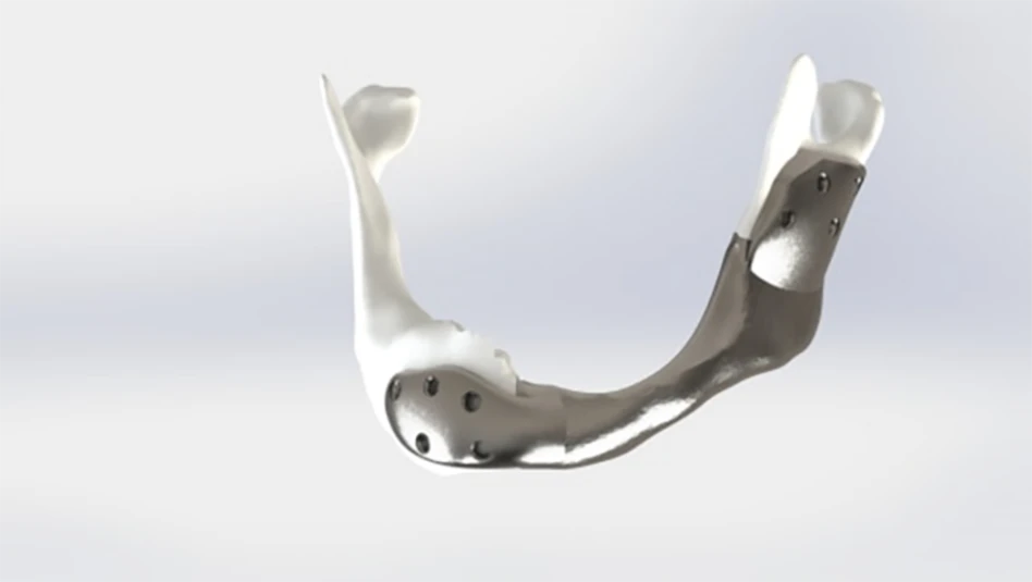 Netherlands Cancer Institute carried out first successful operation with custom 3D-printed titanium lower jaw