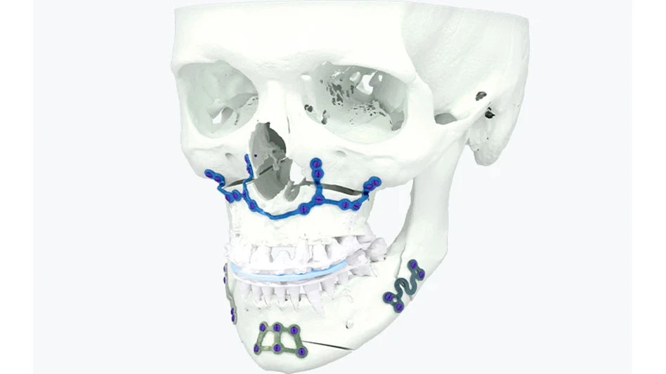 Materialise specializes in the 3D printing of personalized titanium cranio-maxillofacial (CMF) implants.